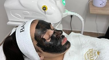 Carbon laser peel (holivudski tretman lica)