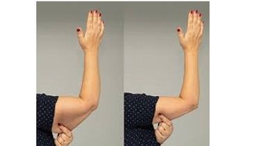 Zatezanje kože ruku (Exilis elite tretman - aparat br 1 u SVETU za neinvazivno zatezanje kože i redukciju obima)