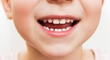 Zalivanje fisura (4 zuba)