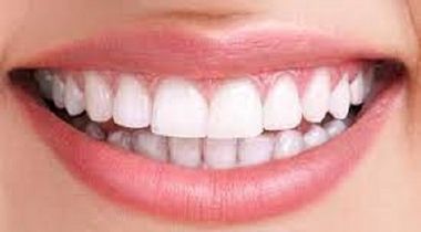 Ordinacijsko izbeljivanje zuba (obe vilice)