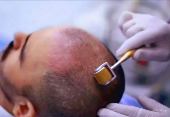 Tretman dermarolerom protiv ćelavosti - idealno za muškarce koji imaju problem opadanja kose!