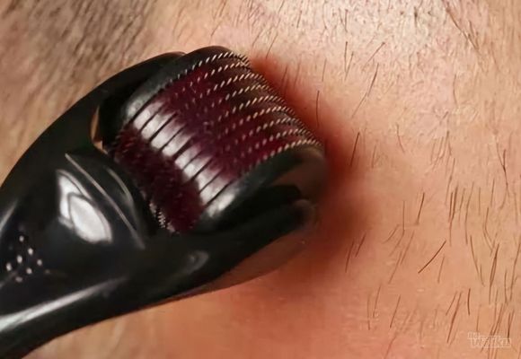 Tretman dermarolerom protiv ćelavosti + čišćenje lica UZ špatulom