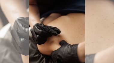 Dry needling akupunkturna tehnika rešavanja bola i napetosti misića bez korišćenja medikamenata 45 min