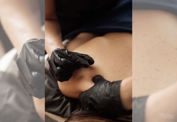 Dry needling akupunkturna tehnika rešavanja bola i napetosti misića bez korišćenja medikamenata 45 min