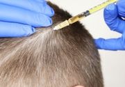 Hair Loss tretman Mezoterapija kose
