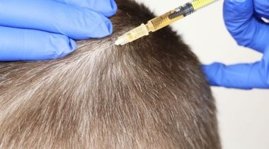 Hair Loss tretman Mezoterapija kose