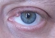 Uklanjanje do 3 manje promene u regiji oka "PLASMA" metodom (ksantelazme, halacion, papillom, fibrom, ciste, keratoze, pigmentacije, ožiljne promene, sve promene na koži kapaka i koži lica)