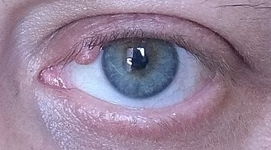 Uklanjanje do 3 manje promene u regiji oka "PLASMA" metodom (ksantelazme, halacion, papillom, fibrom, ciste, keratoze, pigmentacije, ožiljne promene, sve promene na koži kapaka i koži lica)
