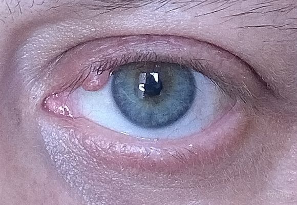 Uklanjanje do 3 manje promene u regiji oka "PLASMA" metodom (ksantelazme, halacion, papillom, fibrom, ciste, keratoze, pigmentacije, ožiljne promene, sve promene na koži kapaka i koži lica)