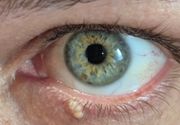 Uklanjanje do 3 manje promene u regiji oka "PLASMA" metodom (ksantelazme, halacion, papillom, fibrom, ciste, keratoze, pigmentacije, ožiljne promene, sve promene na koži kapaka i koži lica)