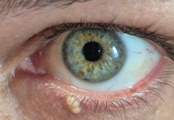 Uklanjanje do 3 manje promene u regiji oka "PLASMA" metodom (ksantelazme, halacion, papillom, fibrom, ciste, keratoze, pigmentacije, ožiljne promene, sve promene na koži kapaka i koži lica)