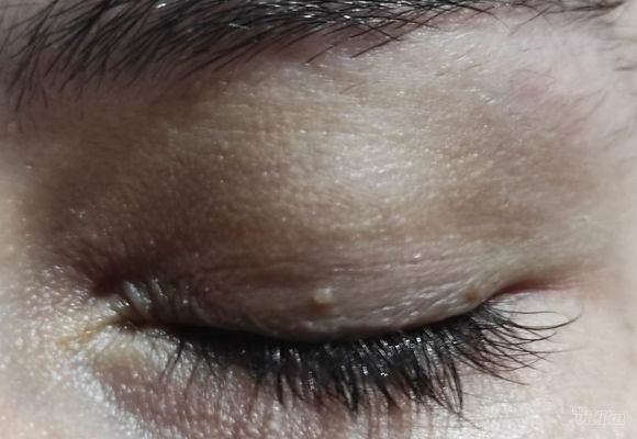 Uklanjanje do 3 manje promene u regiji oka "PLASMA" metodom (ksantelazme, halacion, papillom, fibrom, ciste, keratoze, pigmentacije, ožiljne promene, sve promene na koži kapaka i koži lica)