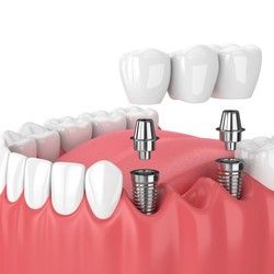 B&B Dental implanti