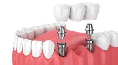 B&B Dental implanti