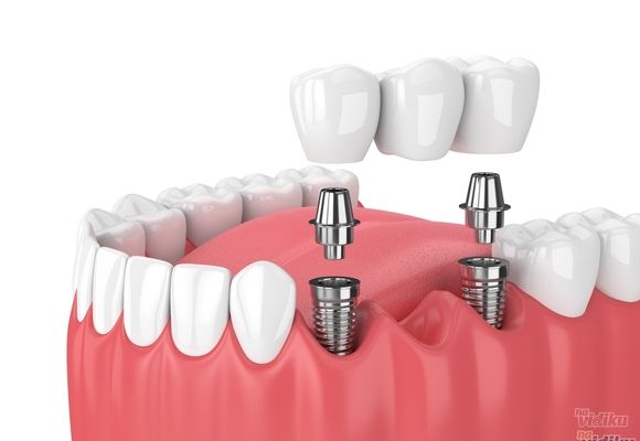 B&B Dental implanti
