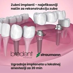 Bredent implanti