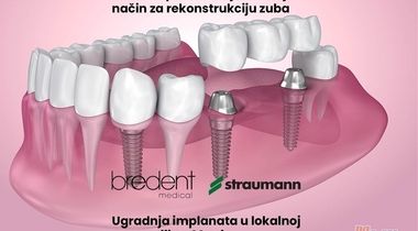 Bredent implanti
