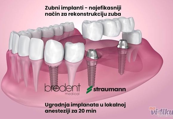 Bredent implanti