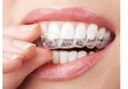 Izbeljivanje zuba (izrada trayeva, kućni tretman)