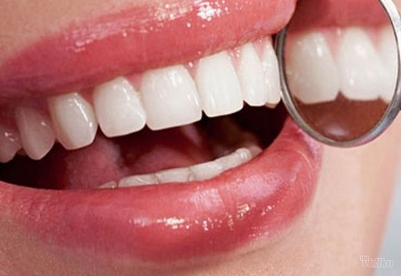 Kućno beljenje zuba uz pomoć splinta - obe vilice