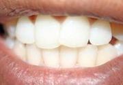 Krunice zubne