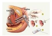 PA bris + kompletne mikrobiološke analize vagine i cerviksa