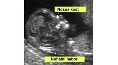 Dabl test + ultrazvučni pregled trudnice vaginalnom sondom