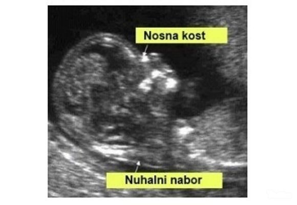 Dabl test + ultrazvučni pregled trudnice vaginalnom sondom