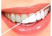 Trajno lasersko izbeljivanje zuba Medium dent u trajanju od sat vremena nanošenjem gela za beljenje 3 puta