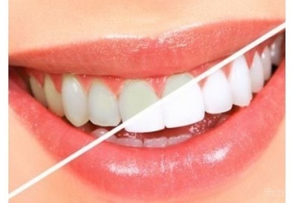 Trajno lasersko izbeljivanje zuba Medium dent u trajanju od sat vremena nanošenjem gela za beljenje 3 puta