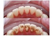 Uklanjanje zubnog kamenca
