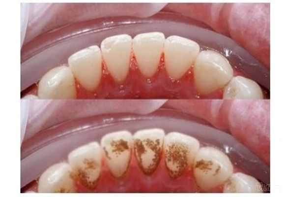 Uklanjanje zubnog kamenca