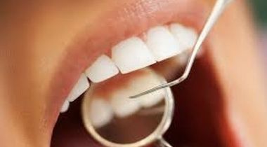 Čišćenje zubnog kamenca, peskiranje i poliranje svih zuba