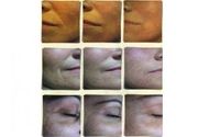 Paket od 3 tretmana Myolift lica + Anti age drenaža lica