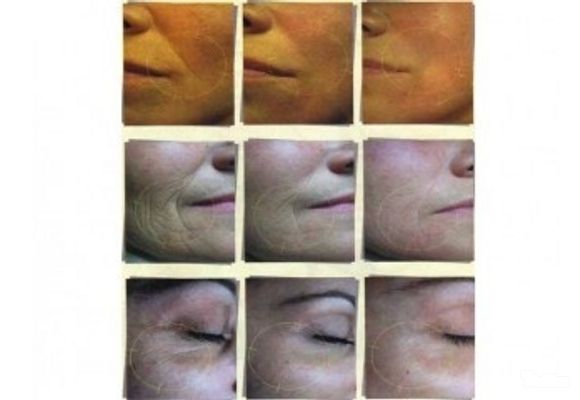 Paket od 3 tretmana Myolift lica + Anti age drenaža lica