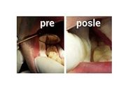 Popravka zuba ili zamena stare amalgamske (sive) jednopovršinske plombe kompozitnom (belom) plombom uz besplatan stomatološki pregled