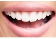 Plombiranje zuba - dvopovršinska (bela) plomba sa poliranjem zuba