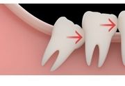 Hirurško vađenje umnjaka i drugih zuba (specijalista oralne hirurgije)