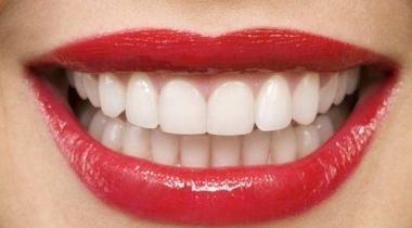 Lasersko izbeljivanje zuba (obe vilice) + uklanjanje kamenca