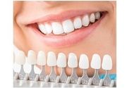 Ordinacijsko beljenje zuba (obe vilice) - 3 tretmana!