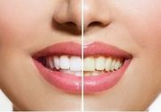 Kozmetičko izbeljivanje zuba 40 minuta (3 do 6 nijansi) - potpuno neinvazivna metoda!