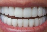 Lasersko izbeljivanje zuba + skidanje kamenca + poliranje + pregled + POKLON četkica i pasta za zube