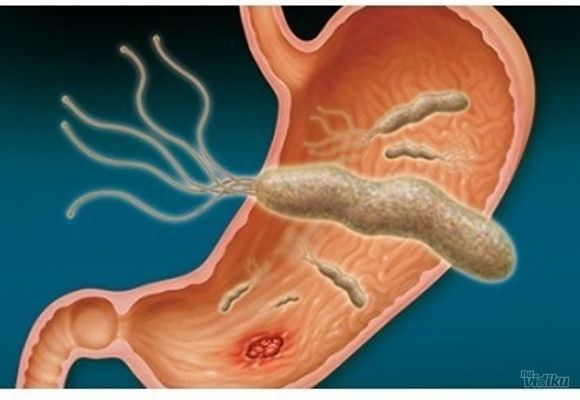 Lečenje homeopatijom - HELIKO BAKTERIJA