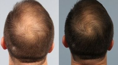 PRP kose - tretman kože glave sopstvenom krvnom plazmom (ceo skalp)