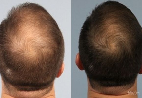 PRP kose - tretman kože glave sopstvenom krvnom plazmom (ceo skalp)
