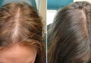 PRP kose - tretman kože glave sopstvenom krvnom plazmom (po regiji)
