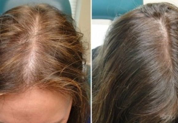 PRP kose - tretman kože glave sopstvenom krvnom plazmom (po regiji)