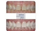 Lasersko izbeljivanje zuba