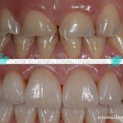 Keramicke fasete 1 - Centar za dentalnu estetiku i implantologiju