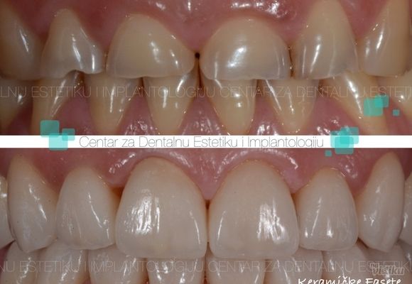 Keramicke fasete 1 - Centar za dentalnu estetiku i implantologiju